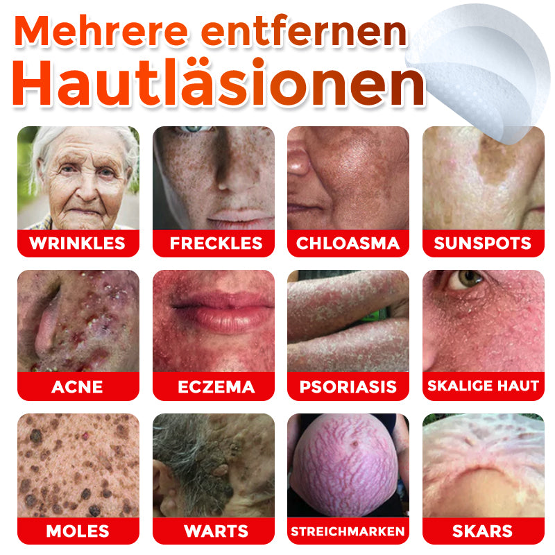 ✅ ODALIT® Mikronadel-Botanisches Hautanhängsel-Entfernungspflaster 🇩🇪 Hergestellt in Deutschland