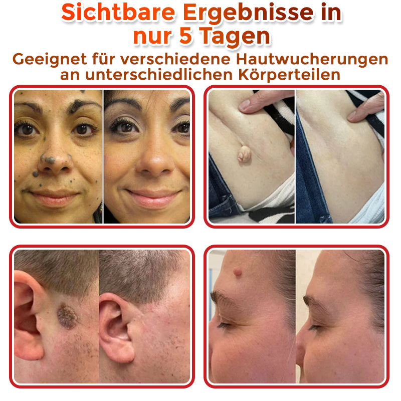 ✅ ODALIT® Mikronadel-Botanisches Hautanhängsel-Entfernungspflaster 🇩🇪 Hergestellt in Deutschland