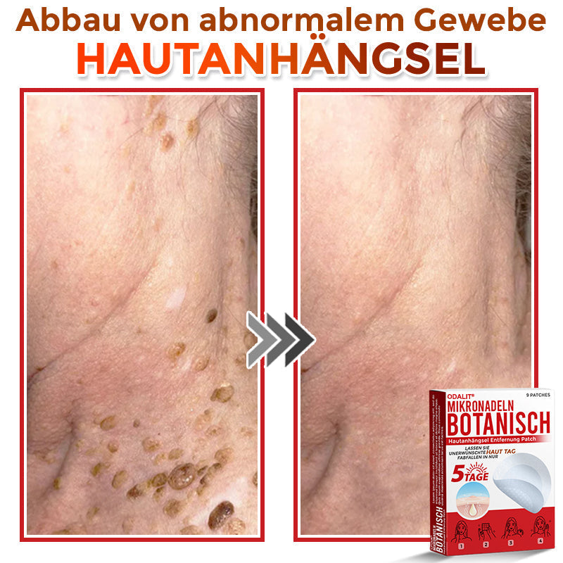 ✅ ODALIT® Mikronadel-Botanisches Hautanhängsel-Entfernungspflaster 🇩🇪 Hergestellt in Deutschland