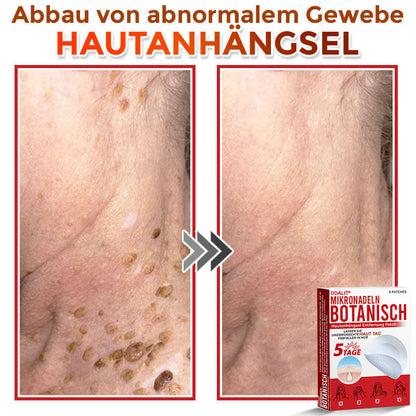 ✅ ODALIT® Mikronadel-Botanisches Hautanhängsel-Entfernungspflaster 🇩🇪 Hergestellt in Deutschland