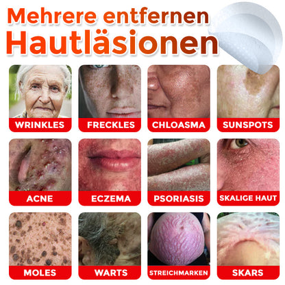 ✅ ODALIT® Mikronadel-Botanisches Hautanhängsel-Entfernungspflaster 🇩🇪 Hergestellt in Deutschland